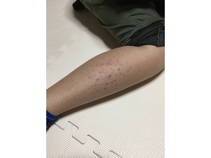 発疹?内出血? , Goo知恵袋